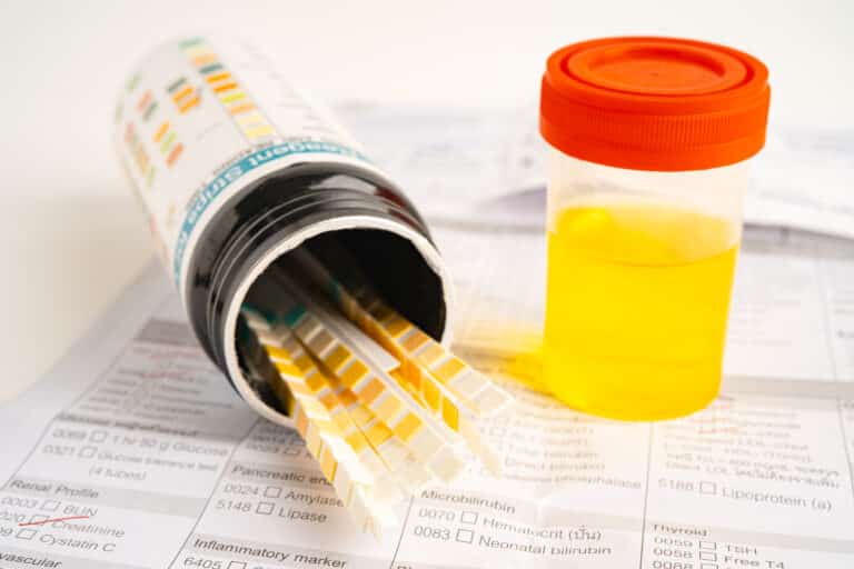 Urinalysis, urine cup with fentanyl test strip pH paper test and comparison chart in the laboratory.