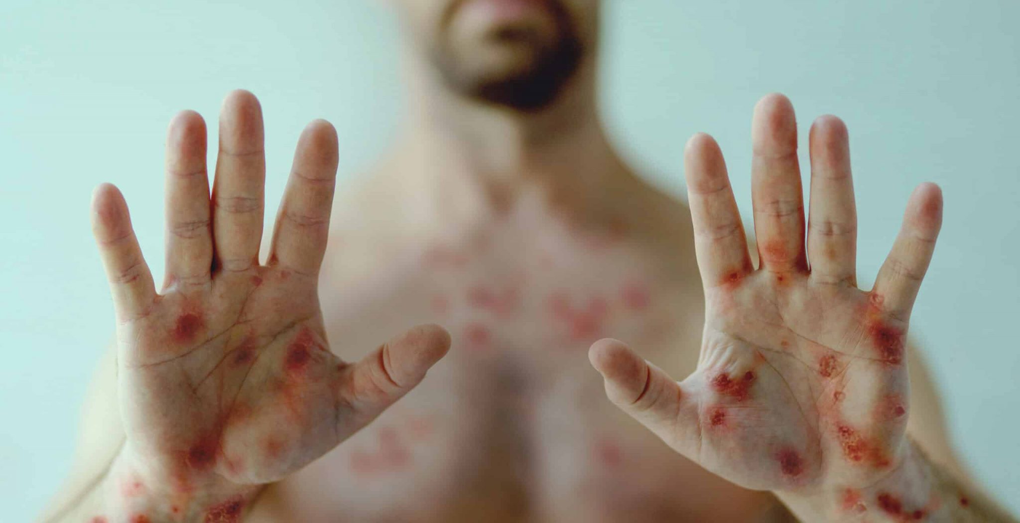 a Male hands affected by blistering rash because of monkeypox or other viral infection on green background