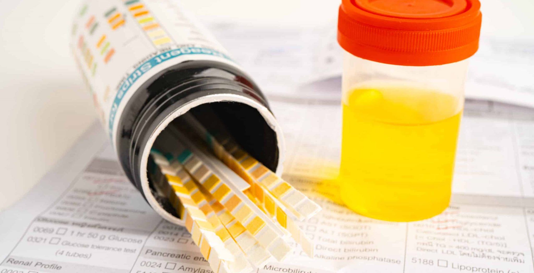 Urinalysis, urine cup with fentanyl test strip pH paper test and comparison chart in the laboratory.